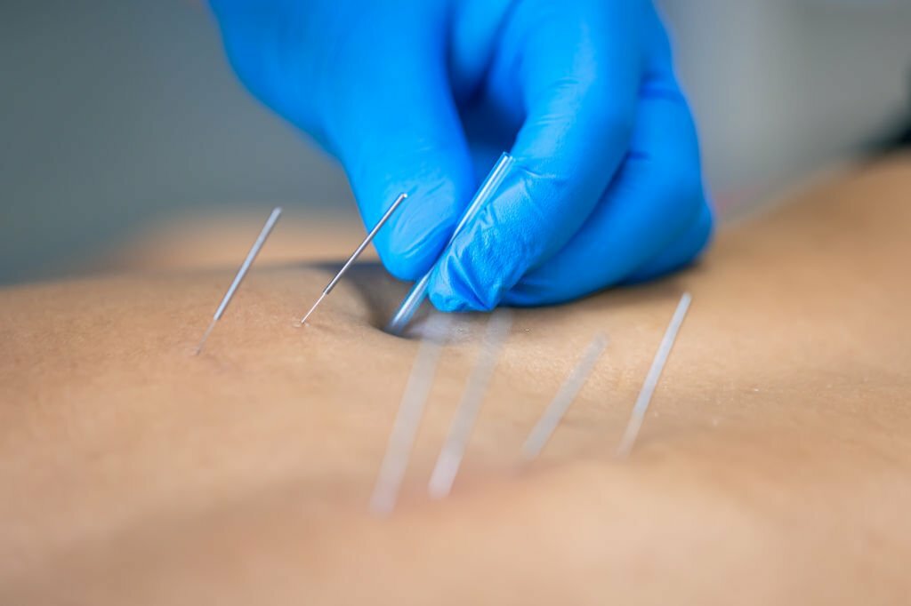 Dry Needling Therapy Techniques